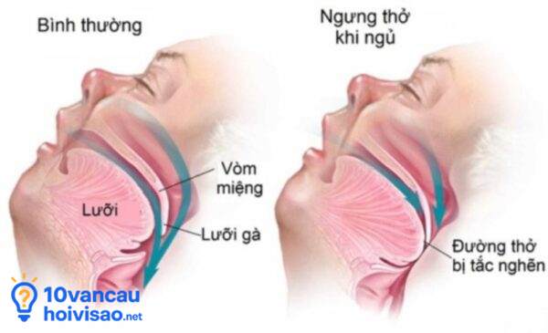 Chứng Ngưng Thở Khi Ngủ