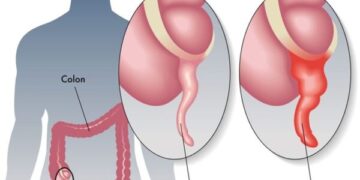 Đau Ruột Thừa Bên Nào Dấu Hiệu Và Triệu Chứng đau Ruột Thừa