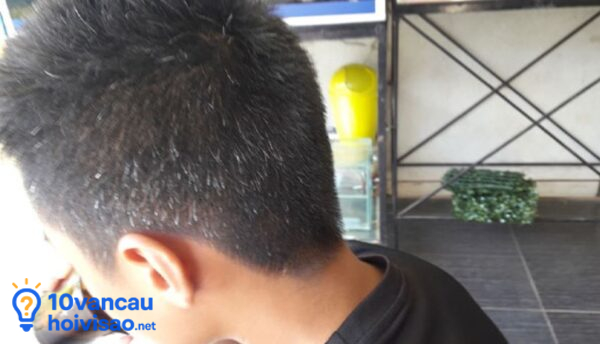 Tóc Bạc Sớm ở Tuổi Dưới 30