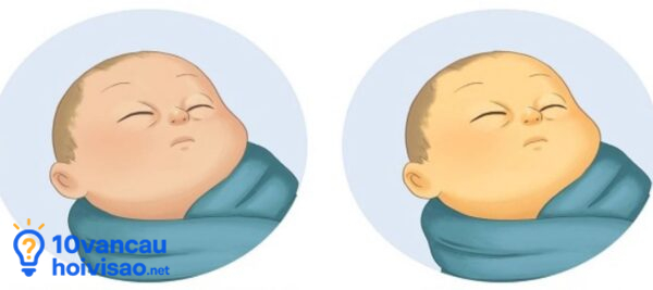 2 Loại Vàng Da ở Trẻ Sơ Sinh